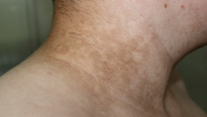 Manchas escuras e acinzentadas na pele podem ser sinal de pré diabetes